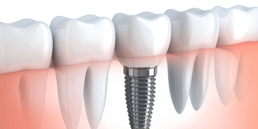 Dental Implants Ajax