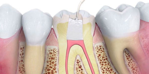 Root Canal Treatment Ajax