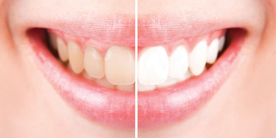 Teeth Whitening Ajax